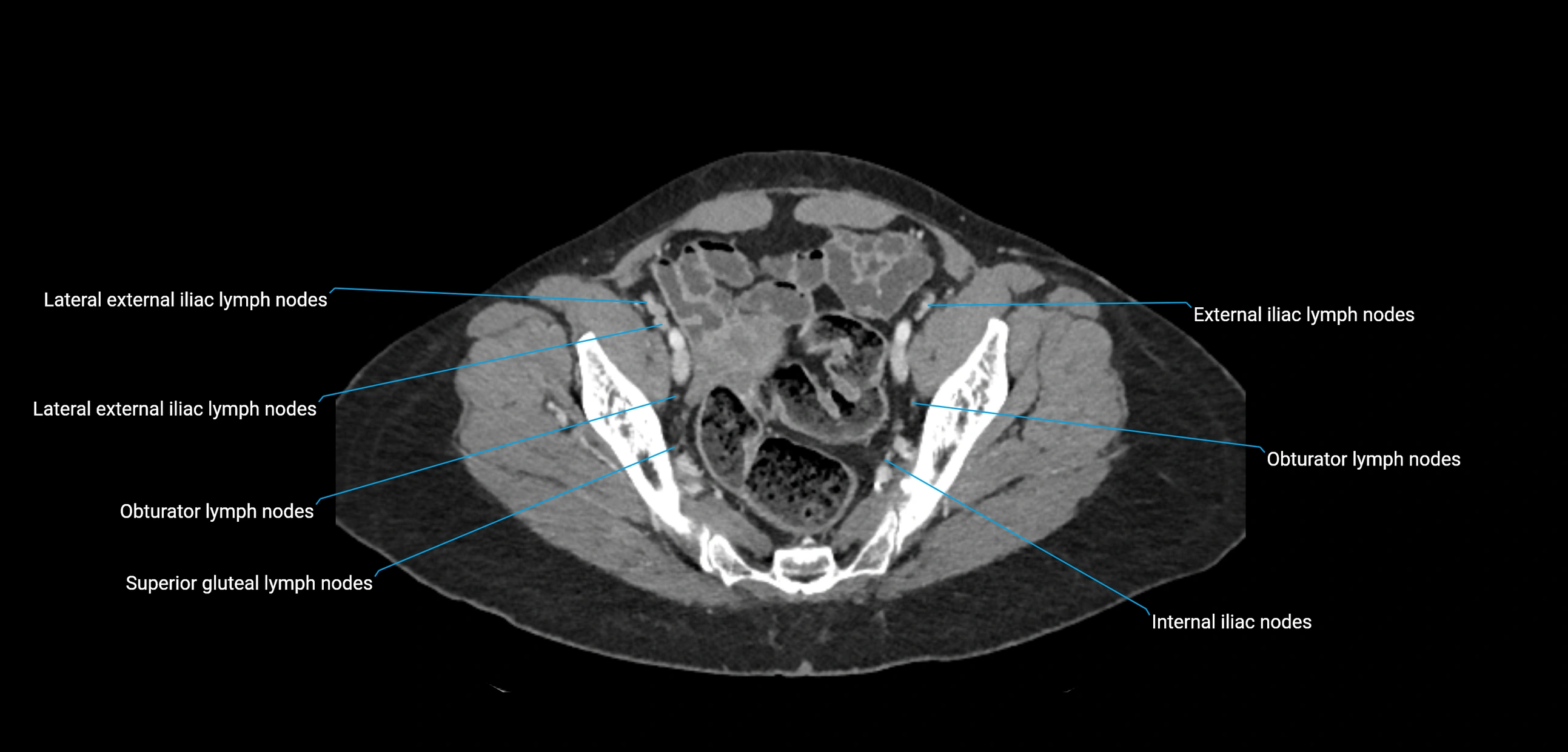 CT ct abdominal lymph nodes  axial cross sectional anatomy  enchanced radiology image -img-00002-00355.webp